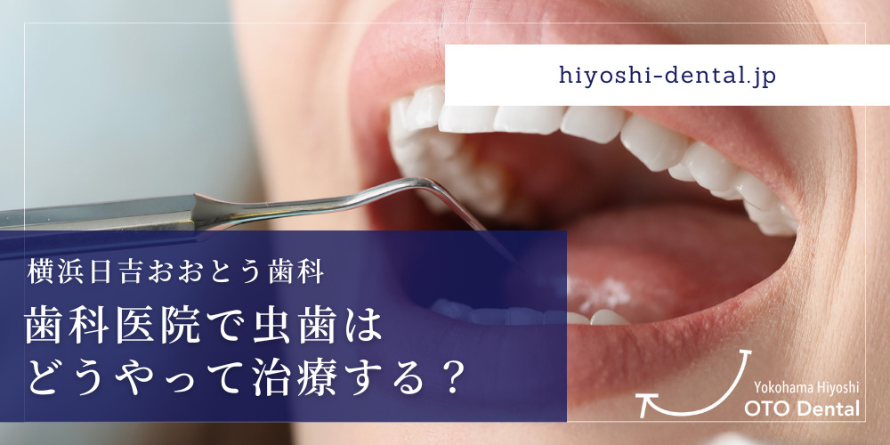 横浜日吉おおとう歯科｜歯科医院で虫歯はどうやって治療する？