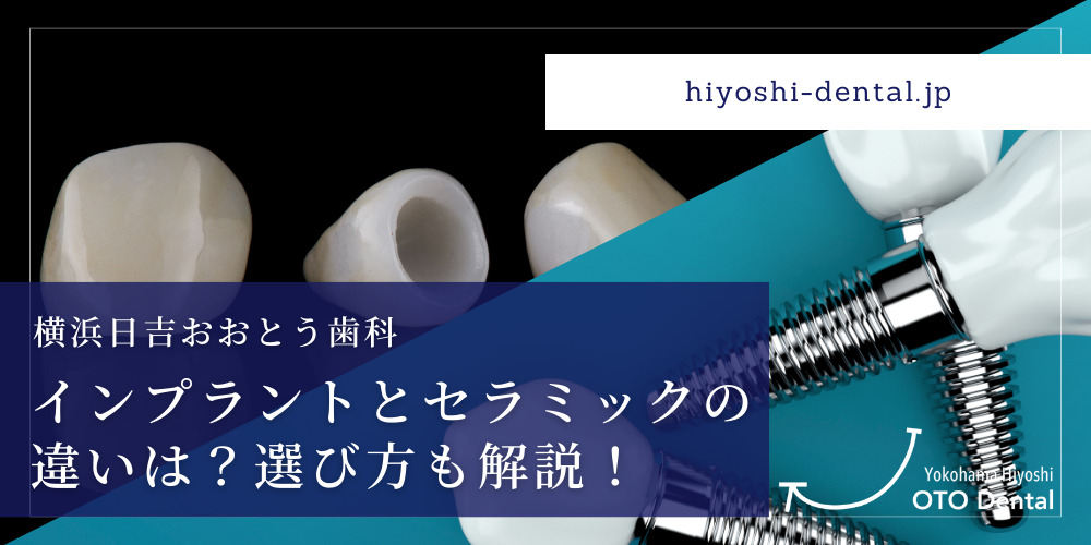 インプラントとセラミックの違いは？選び方も解説！
