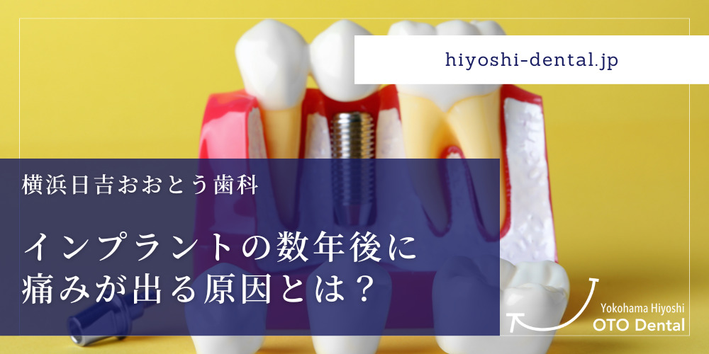 インプラントの数年後に痛みが出る原因とは？