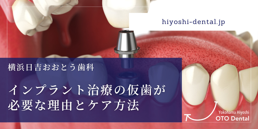 インプラント治療の仮歯が必要な理由とケア方法