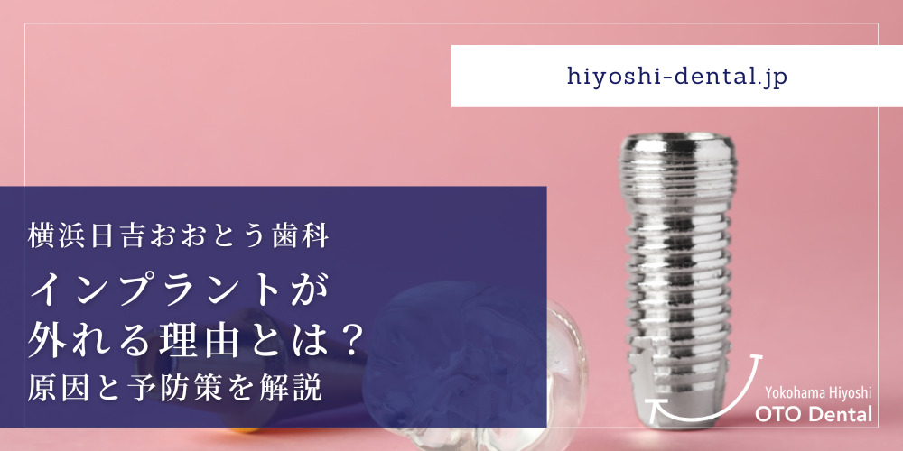 インプラントが外れる理由とは？原因と予防策を解説